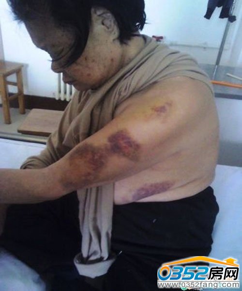 老人遍體鱗傷
